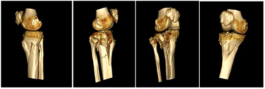 CT reconstruction.