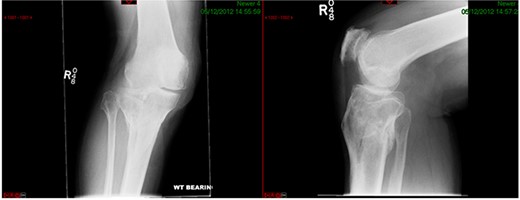 Healed fracture position.
