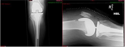 Immediate post-op radiograph.