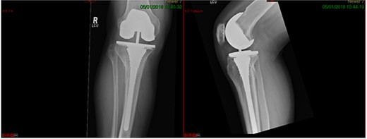 7-year post-op radiograph.