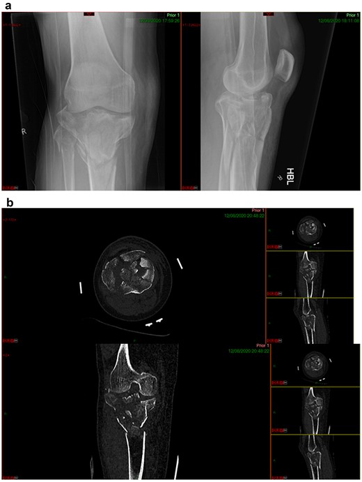 (a) Post-injury radiograph, (b) post-injury CT scan.
