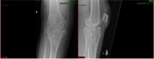 Pre-operative healed fracture.