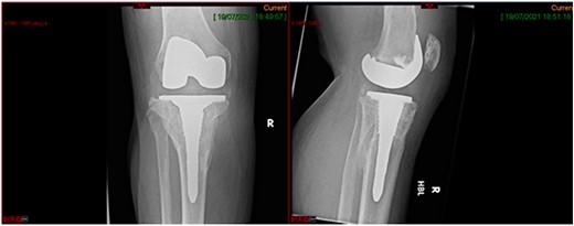 6-month post-operative knee replacement.