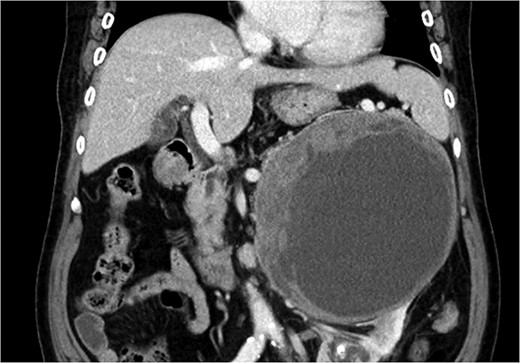 APCT showed a 16-cm-sized heterogeneous tumor in the left adrenal gland.