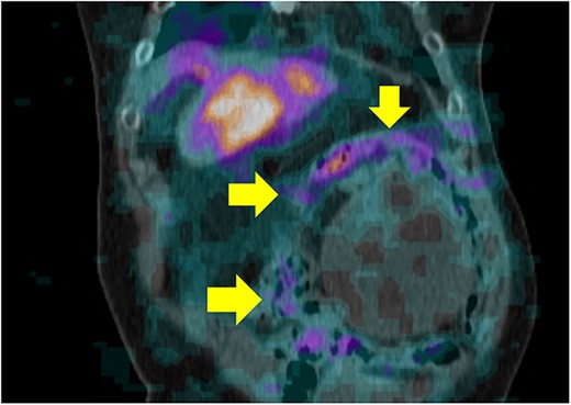 I-123 MIBG SPECT showed huge mass with mild peripheral uptake of the left adrenal gland.