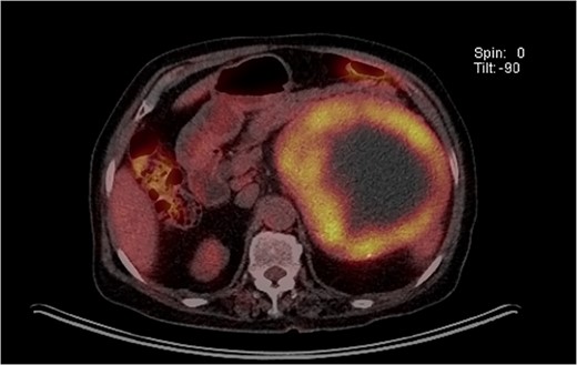 PET showed the accumulation of FDG in the left adrenal tumor and lymph nodes in the para-aortic area.