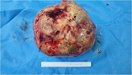 A well-demarcated and solid mass measuring 16.8 × 11.8 × 11.5 cm.
