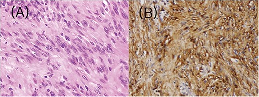Histologic and immunohistochemical features of the tumor. (A) Spindle cells are arranged in fascicles with intervening stroma. (B) Cells showed strong S100 immunoreactivity.