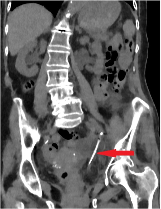 Coronal section of abdomen and pelvis non-contrast CT: The urethral catheter migrates into the left ureter up to the mid-ureter.
