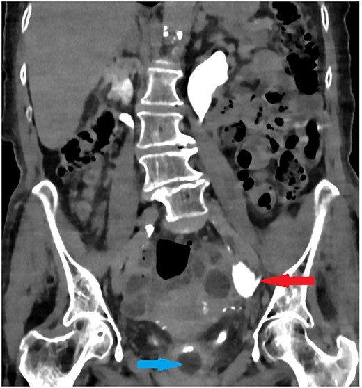Coronal section of abdomen and pelvis contrast CT 24 h from the initial CT: The new urethral catheter balloon in the bladder (blue arrow). Contrast extravasates the left ureter at the site of the old catheter balloon (red arrow).