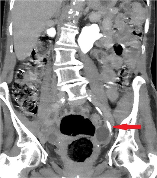 Coronal section of abdomen and pelvis contrast CT 2 weeks after the injury: Contrast flows normally without extravasation or stricture in the left ureter.