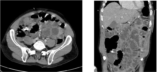 Axial and coronal CT slices showing radiopaque object in the right lower abdominal quadrant.