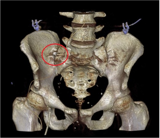 CT reconstruction showing a tooth near the pelvic brim.