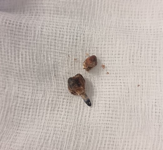 Specimen photograph of the retrieved tooth containing a metallic filling.