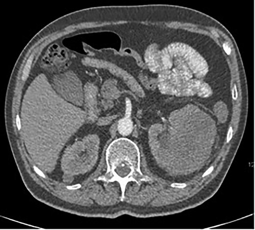 Axial CT showing a large 12-cm left renal heterogenous mass; no renal obstruction, hydronephrosis or calculus; the mass abuts the lower edge of the spleen.