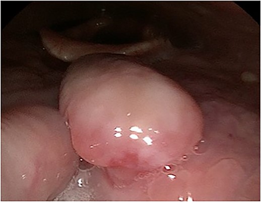 Flexible nasendoscopy image of the pedunculated RCC on the dorsum of the tongue.