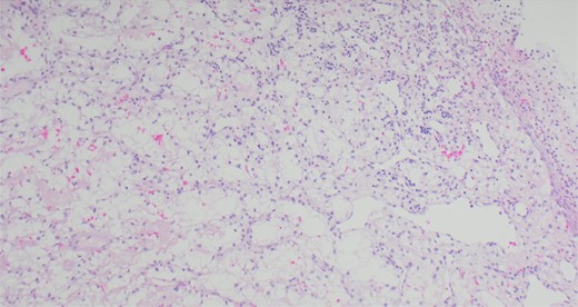 Ulcerated squamous mucosa with underlying metastatic RCC.