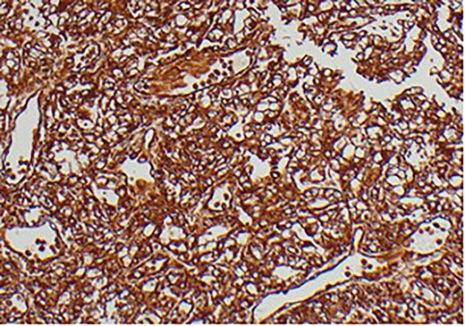Immunohistochemical staining confirming Vimentin positivity and the presence of malignant RCC over a benign Oncoytoma.