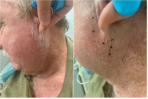 Topical anesthesia applied approximately 30 min prior to the procedure (left). Six injection points marked according to existing literature for post-surgical FBS (right).