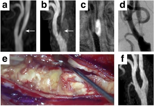 Clinical presentation A mild stenosis at the right carotid artery (white arrows, a) progressed in 3 years (white arrows, b), requiring surgical intervention. The carotid plaque showed a high signal intensity on T1WI (c) with 93% stenosis assessed by the NASCET criteria (d). A standard carotid endarterectomy was performed (e) without any complication (f).