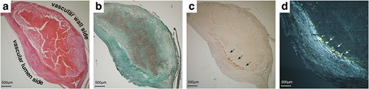 Histological and immunohistochemical findings. Hematoxylin and eosin staining revealed carotid intima’s eccentric fibrosis (a). Masson’s trichrome staining showed a neovascularised plaque surrounded by smooth muscle fibers (b). Potassium permanganate (KMnO4)-DFS stain showed positive (black arrows, c), and the deposits were apple-green-birefringence positive (white arrows, d).