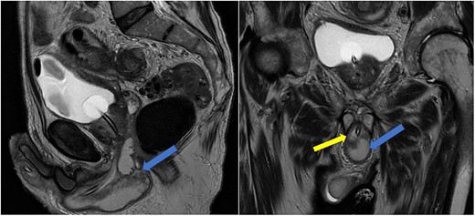 Case 1: sagittal and coronal T2-weighted images showing the collection (blue arrow) inferior to the prostate, and involving the corpus spongiosum (yellow arrow).