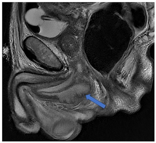 Case 1: T2-weighted axial image 4 months later, showing slight reduction in the size of the collection (arrow).