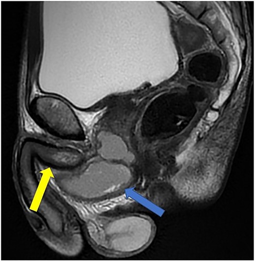 Case 2: T2-weighted sagittal MRI image demonstrating a complex, cystic perineal collection (blue arrow), seen in relation to one of the corpus cavernosa (yellow arrow).