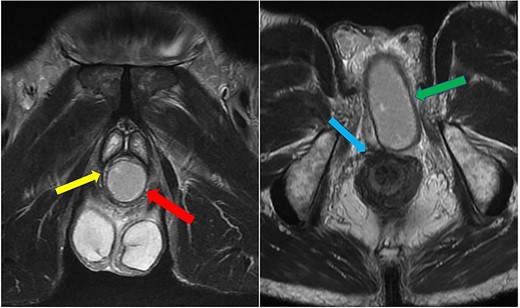 Case 2: coronal and axial T2-weighted images demonstrating the collection (red and green arrows) significantly compressing the urethra and corpus spongiosum (yellow arrow) to the right of the midline, and close to, but not involving, the anal sphincter (blue arrow).