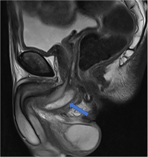 Case 2: T2-weighted sagittal image showing a reduced perineal collection post-aspiration.