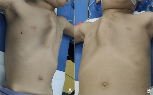 Chest wall appearance before operation. (A) Side and (B) front view.