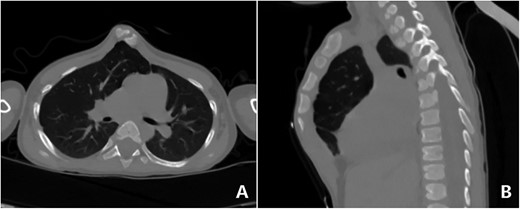 CT examination. (A) Section and (B) sagittal view.