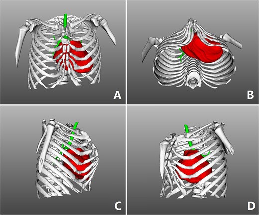 Three-dimensional examination. (A) Front view, (B) bottom view, (C) right side view and (D) left side view.