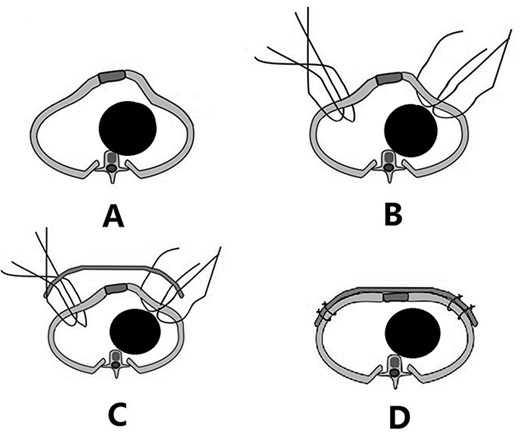 Schematic diagram of Wenlin procedure. (A) Section image of deformity; (B) position of the fixed steel wires; (C) steel bar was placed; and (D) after the steel bar is fixed, the median protrusion is flattened and the depressions on both sides are lifted.