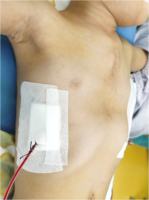 Chest wall appearance after operation.