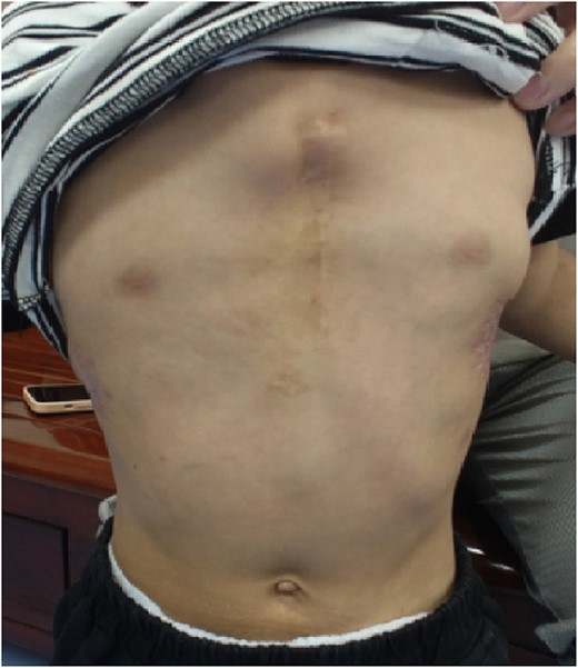 Chest wall appearance 1 year after operation.