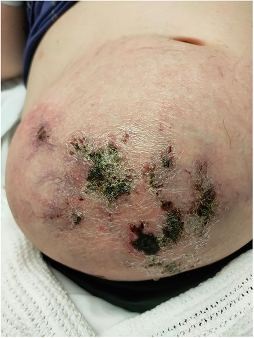 Gravid uterus herniating through the anterior abdominal wall incisional hernia with overlying skin necrosis at 30 weeks of gestation.