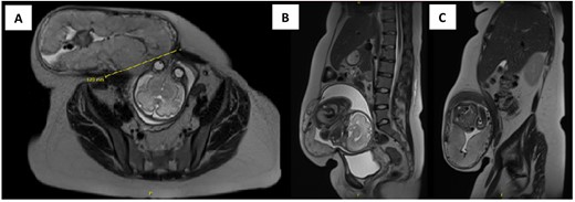Axial (A) and sagittal (B and C) view of MRI of the abdomen and pelvis showing herniation of the gravid uterus into the right anterior abdominal wall with the neck of defect measuring 12 × 12 cm.