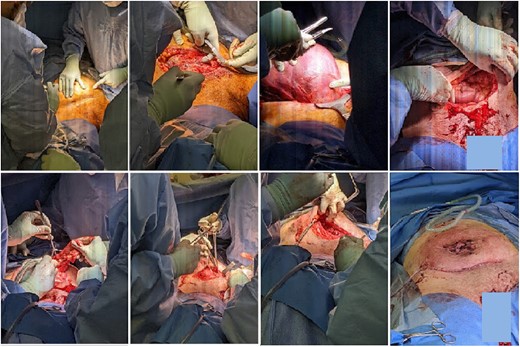 Intraoperative pictures of lower uterine segment caesarean section and abdominal wall hernia repair.