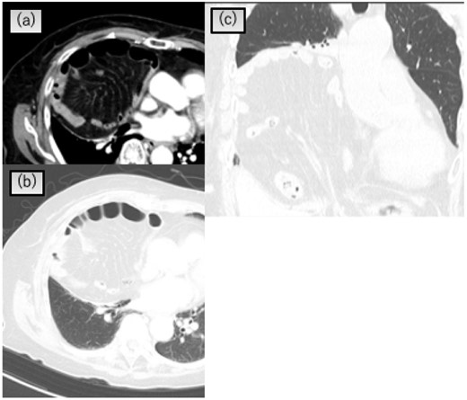 Chest CT scan showing that the transverse colon and greater omentum in the right pleural cavity and atelectasis of the right lower lobe. (a) and (b) Axial view, (c) coronal view.