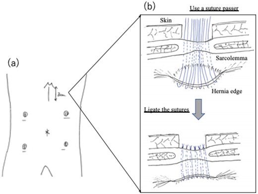 (a) Laparoscopic port site position. (b) Schematic diagram of surgery. A diaphragmatic defect was closed securely by the extra-abdominal suture method. The defect was closed by placing non-absorbable sutures passing through the full thickness of the anterior abdominal wall and the posterior rim of the defect.