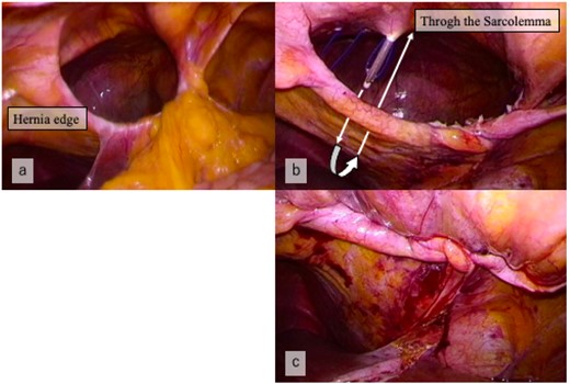 (a) Laparoscopic view showing the hernia orifice before suturing. (b) The defect closed by the extra-abdominal suture method, using suture passer. (c) Laparoscopic view showing closure of the hernia orifice.