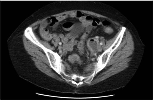 Initial CT demonstrating a gas containing the left adnexal mass and normal sigmoid colon.