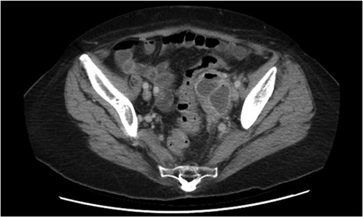 Repeat CT scan demonstrating thickening of the sigmoid colon adjacent to the adnexal mass.