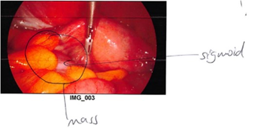 Intraoperative photograph demonstrating the colo-salpingeal fistula.