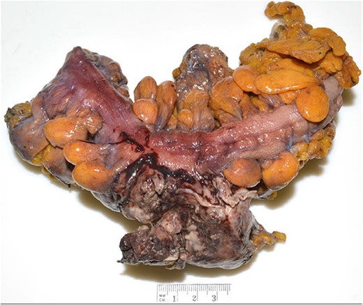 Operative specimen demonstrating the colo-salpingeal fistula.