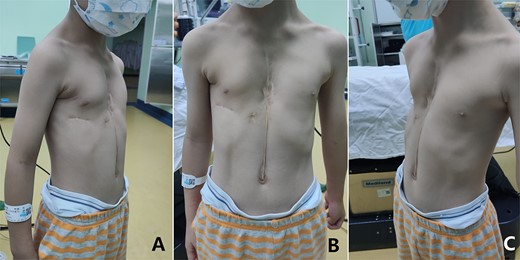 Appearance of chest wall before operation.