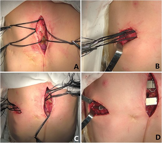 (A) Median operative field; (B) Right chest wall operative field; (C) The steel wire guiding lines were placed completely; (D) The depressions were completely eliminated with two steel bars.