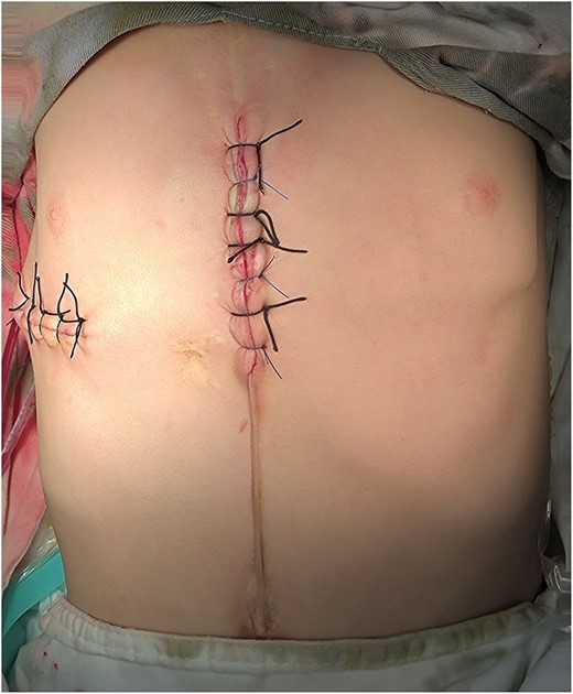 Appearance of chest wall after operation.