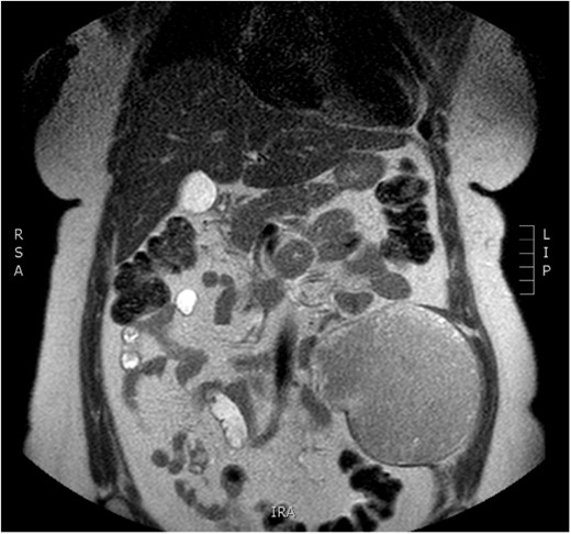 Preoperative MRI—axial plane. T1 weighted image. High sign density of the lesion.